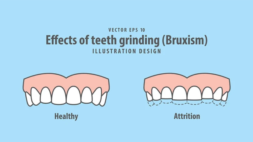 an image of effects of teeth grinding