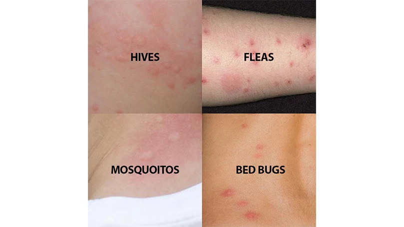 an image of insect bites differences