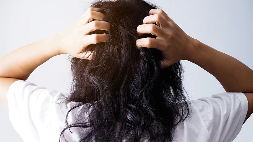 An image of an Asian woman having head lice infestation.