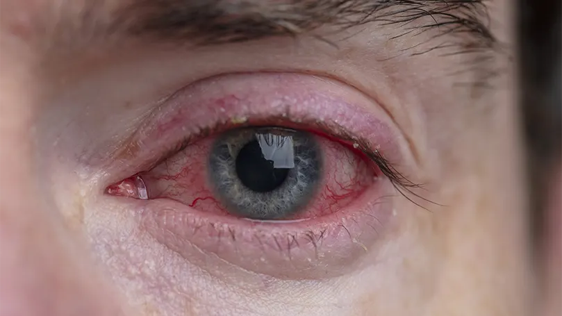 An image of eye lid problems with eye redness.