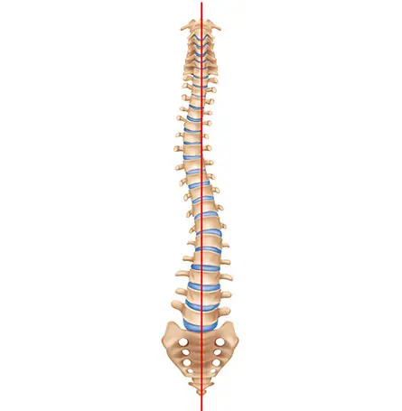 An image of the spine with scoliosis